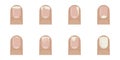Types of onychosis affecting fingernails. Royalty Free Stock Photo