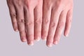 Onychomycosis or fungal nail infection on damaged nails after gel polish, onychosis. Longitudinal ridging nails with psoriasis,