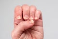 Onychomycosis or fungal nail infection on damaged nails after gel polish, onychosis. Longitudinal ridging nails with