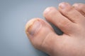 Onychomycosis, The initial stage of mycosis. Big toe infected with fungal bacteria