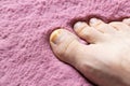 Onychomycosis, the initial stage of ringworm. Big toe infected with fungal bacteria, Background pacific pink