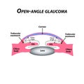 Open-angle glaucoma. A common type of glaucoma. The anatomical structure of the eye. Infographics. Vector illustration