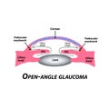 Open-angle glaucoma. A common type of glaucoma. The anatomical structure of the eye. Infographics. Vector illustration