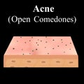 Open comedones. Acne on the skin. Dermatological and cosmetic diseases on the skin of the face acne. Infographics