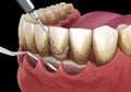 Open curettage: Scaling and root planing conventional periodontal therapy. Medically accurate 3D illustration of human teeth