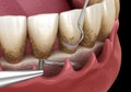 Open curettage: Scaling and root planing conventional periodontal therapy. Medically accurate 3D illustration of human teeth
