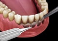 Open curettage: Scaling and root planing conventional periodontal therapy. Medically accurate 3D illustration of human teeth