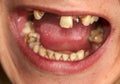 Open mouth with broken, diseased teeth affected by caries and periodontitis. Steel pin in the gum for the installation of a dental