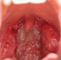 Open mouth view of tonsils