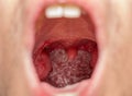 Open mouth view of tonsils