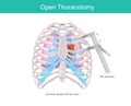 Open Thoracotomy. Infographic.