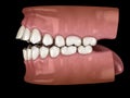 Openbite dental occlusion Malocclusion of teeth . Medically accurate tooth 3D illustration