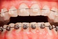 Opened mouth with ceramic and metal braces