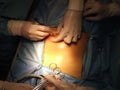 Operation in the abdominal