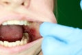 Painful ulcer and stomatitis on the mucous cheek of a girl. After the operation to remove the wisdom teeth. Stitches and