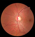 Ophthalmic image detailing the retina and optic nerve inside a healthy human eye. Health protection concept