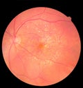 Ophthalmic image detailing the retina and optic nerve inside a healthy human eye. Health protection concept