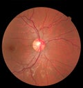 Ophthalmic image detailing the retina and optic nerve inside a healthy human eye. Health protection concept