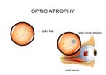 Optic nerve atrophy Royalty Free Stock Photo