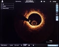 optical coherence tomography oct image angiography catheter lab atherosclerosis Royalty Free Stock Photo