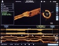 optical coherence tomography oct image angiography catheter lab atherosclerosis