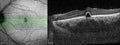 Optical Coherence Tomography