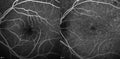 Optical Coherence Tomography