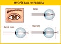 Optical human eye defects. Myopia and hyperopia. Anatomical structure of human eye, Stock vector Royalty Free Stock Photo