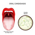 Oral candidiasis. oral thrush yeast infection Royalty Free Stock Photo