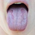 Oral Candidiasis or Oral trush Candida albicans, yeast infection on the human tongue close up, common side effect when using a