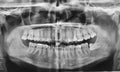 dental x-ray with impacted wisdom tooth Royalty Free Stock Photo