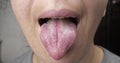 oral disease white coating on the tongue, woman tongue cancer