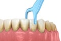 Oral hygiene: using toothpick dental floss to remove food stuck from teeth. Medically accurate dental 3D illustration