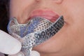 Oral rehabilitation process, partial removable prosthesis