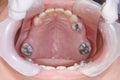 Oral rehabilitation process, partial removable prosthesis