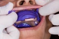 Oral rehabilitation process, partial removable prosthesis