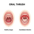 Oral thrush. Candidiasis. Symptoms.Candida infections of the mouth. Oropharyngeal candidiasis.Vector.