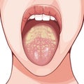 Oral thrush is an infection caused by the Candida albicans fungus.