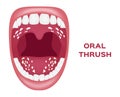 Oral thrush . white tongue