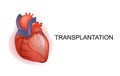 Organ transplantation. Heart. Body parts.