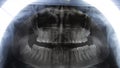 Original black and white x-ray teeth scan. Upper teeth with dental brace Royalty Free Stock Photo