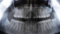 Original black and white x-ray teeth scan. Upper teeth with dental brace Royalty Free Stock Photo
