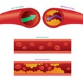 Normal Artery and Narrow Artery because Cholesterol Fat Cell