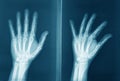 Original radiography of human hand