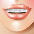 Orthodontic care