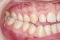 Orthodontic condition