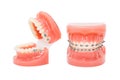 Orthodontic model and dentist tool - demonstration teeth model of varities of orthodontic bracket or brace. Metal and Royalty Free Stock Photo