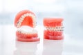 Orthodontic model and dentist tool - demonstration teeth model of varities of orthodontic bracket or brace. Metal and Royalty Free Stock Photo