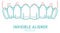Orthodontic silicone trainer. Invisible braces. Upper jaw.