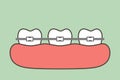 Orthodontic teeth or dental braces